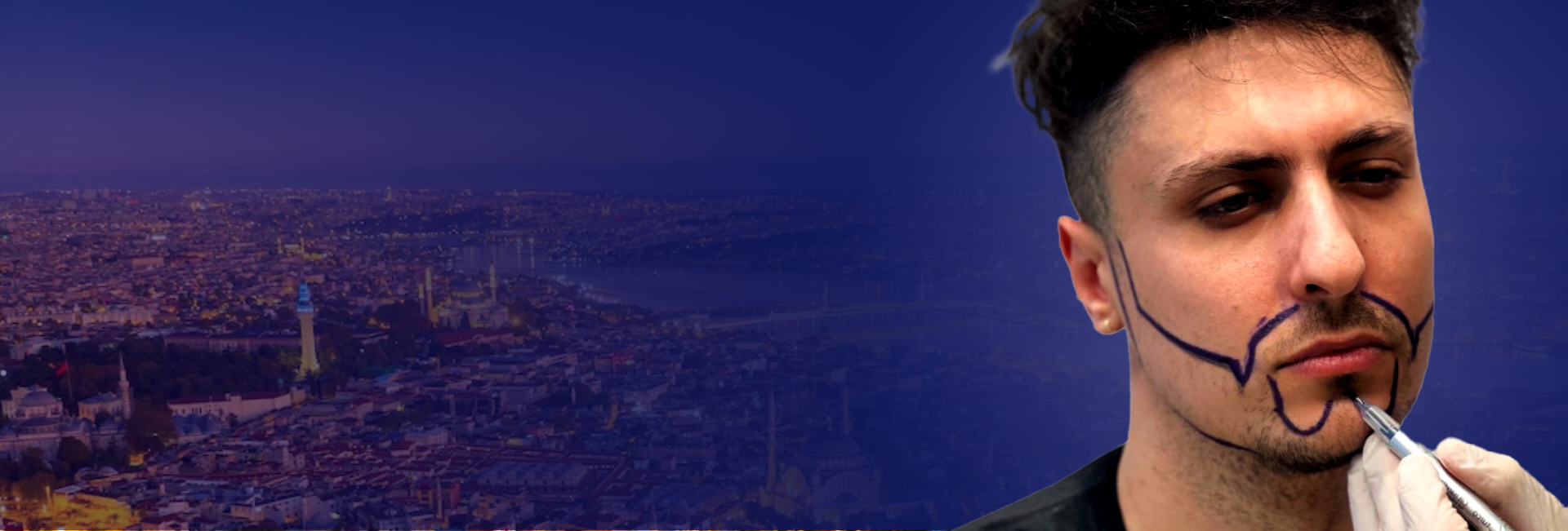 Treatment Hair Transplant – Beard Transplant