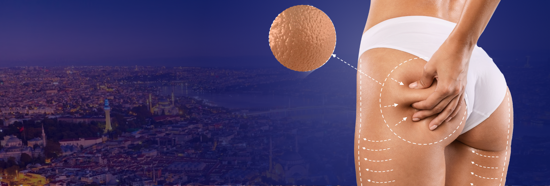 Treatment Brazillian Butt-Lift