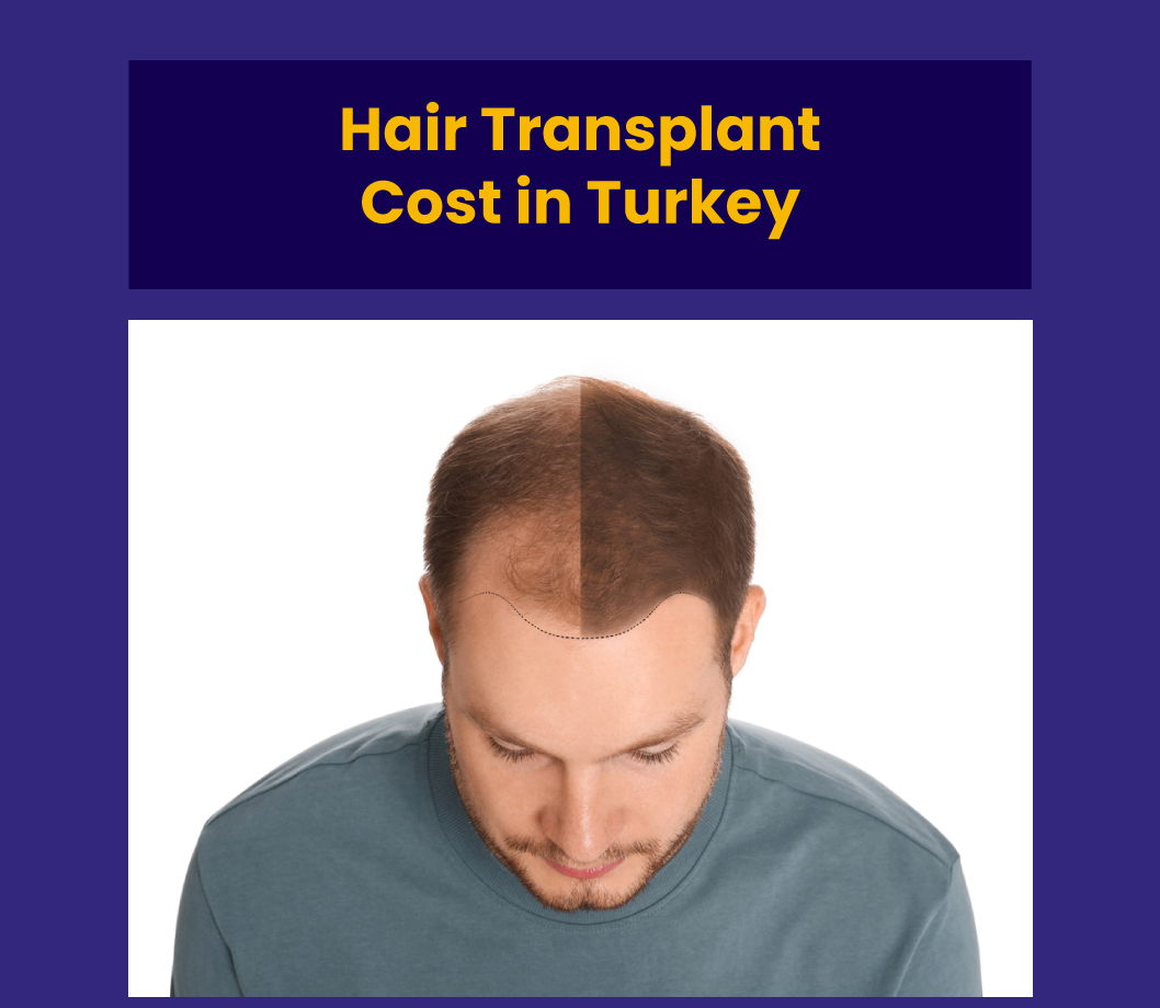 Hair Transplant Turkey Cost in 2026: All Questions Answered