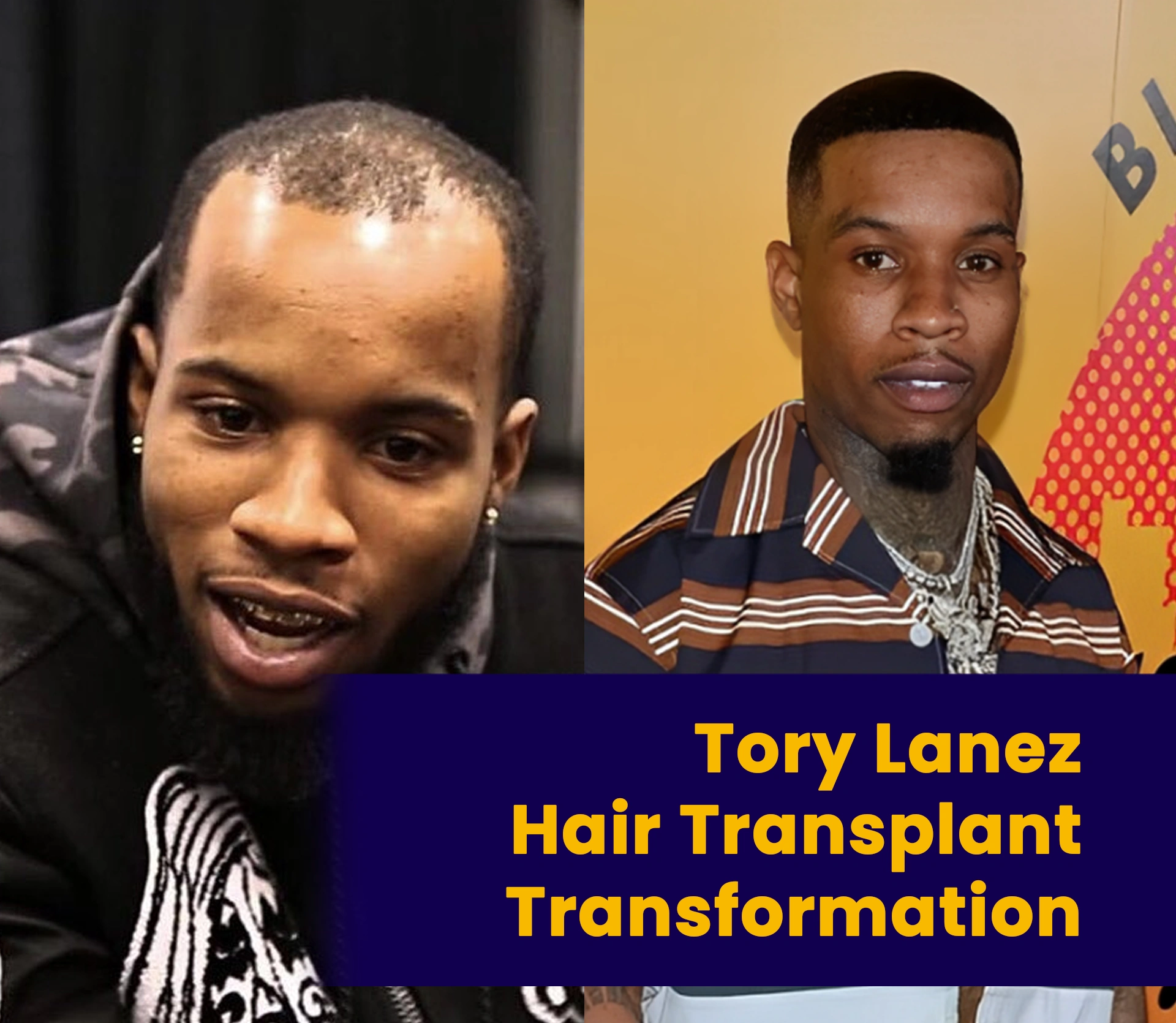 Tory Lanez Hair Transplant Transformation