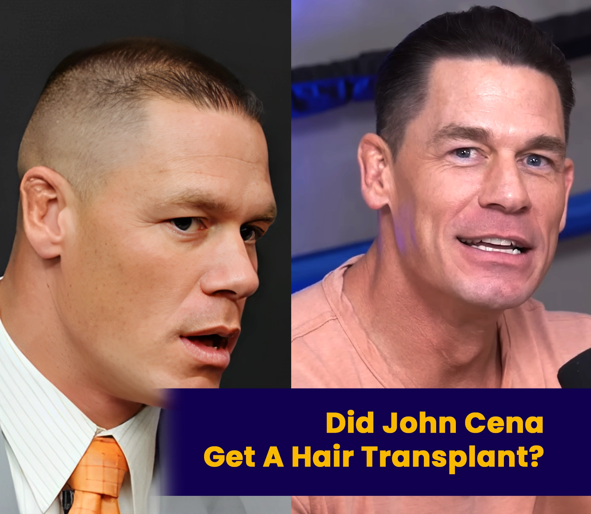 In the world of professional wrestling and Hollywood, appearances matter. And when it comes to style, physique, and image, few are as closely watched as John Cena. Lately, a new buzz is making the rounds  Did John Cena get a hair transplant? Fans have noticed a transformation in Cena’s hairline over the years. From his classic buzz cut to a fuller, more defined hairstyle in recent public appearances, the speculation about a John Cena hair transplant is louder than ever. Let’s dig into the details, explore the evidence, and look at what the experts say. The Hairline Evolution: From Buzz Cut to Fuller Look Throughout his wrestling career, John Cena maintained a short haircut that was appropriate for the ring; but, as time passed, spectators began to see more hairline and muted thinning signs. Fast-forward to recent red carpet events and interviews, and something's clearly changed. His hair appears thicker, with a more youthful hairline and density that wasn't noticeable before. This has only fueled the John Cena hair transplant rumors. Experts Weigh In: Did He or Didn’t He? Although John Cena has never acknowledged in public that he had a hair transplant, many hair restoration experts believe that his most recent appearance is in line with contemporary FUE (Follicular Unit Extraction) techniques, which are a common way to achieve results that look natural with little scarring. The volume and shape of the hairline have significantly improved when comparing pictures taken a few years ago with those taken today. This visual proof is more than sufficient for many fans to conclude that a John Cena hair transplant is probably real and not just a rumor. In order to achieve natural, undetectable results, discretion and professionalism are crucial, as demonstrated by other celebrity makeovers like Gordon Ramsay's and Elon Musk's hair transplants. What About the "John Cena Bald" Look? Fans started to point out John Cena's receding hairline, which is the main reason for the phrase "John Cena bald" became popular at one point and not because he shaved his head. He doesn't appear to be thinning or balding in recent pictures, so that phase appears to be over. One thing is certain: Cena's hair has returned, regardless of the styling, lighting, or medical procedures used. Additionally, John Cena's transformation is an inspiration to many men who once found relatable in his bald memes. Thinking About Hair Restoration? Get to Know Grace Touch Clinic Look no further than Grace Touch Clinic, the reputable name in cutting-edge hair restoration, if hearsay of John Cena having a hair transplant has left you considering your own options. Considering Hair Restoration?Link with Grace Touch Clinic New Methods: Grace Touch Clinic uses the latest and new medical innovations in FUE and PRP treatment to achieve the safest and most effective results. Personalized Consultations: Their hair and skin are examined carefully to provide them with the appropriate personalized treatment plan. Natural-Looking Results: Clients at Grace Touch Clinic possess natural hairlines that give them an improved appearance and feel confident about their appearance, similar to renowned celebrities. Expert Team: You are in expert care at each step of the treatment due to expert surgeons and hair experts. Grace Touch Clinic can offer you empathetic, discreet, and expert advice whether you are just starting to experience hair thinning or you are ready for a full restoration procedure. At Grace Touch Clinic, where confidence begins with a step, book your free consultation today. Book your free consultation at Grace Touch Clinic today where confidence begins with a single step.