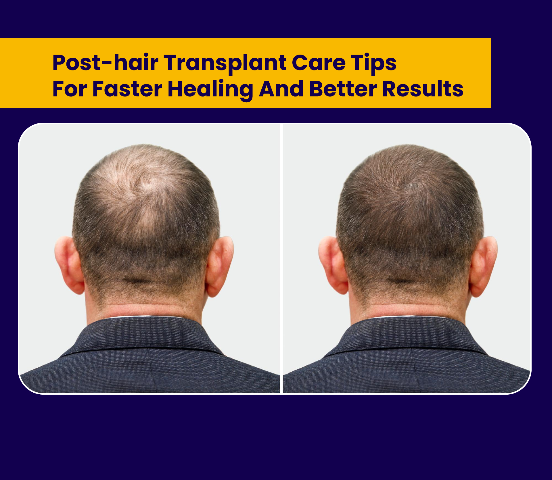 Post-Hair Transplant Care Tips for Faster Healing and Better Results
