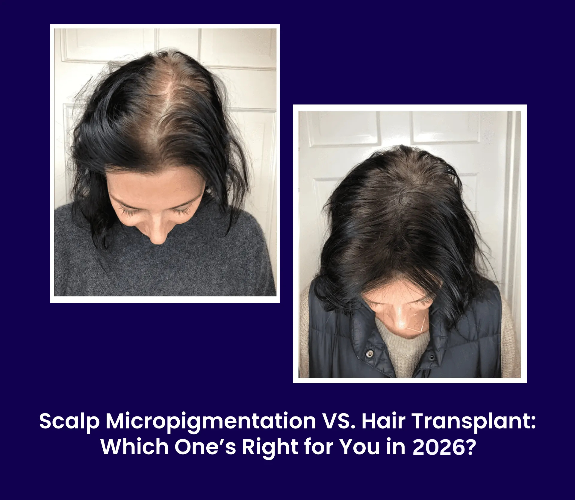 Scalp Micropigmentation vs Hair Transplant: Which One’s Right for You in 2026?