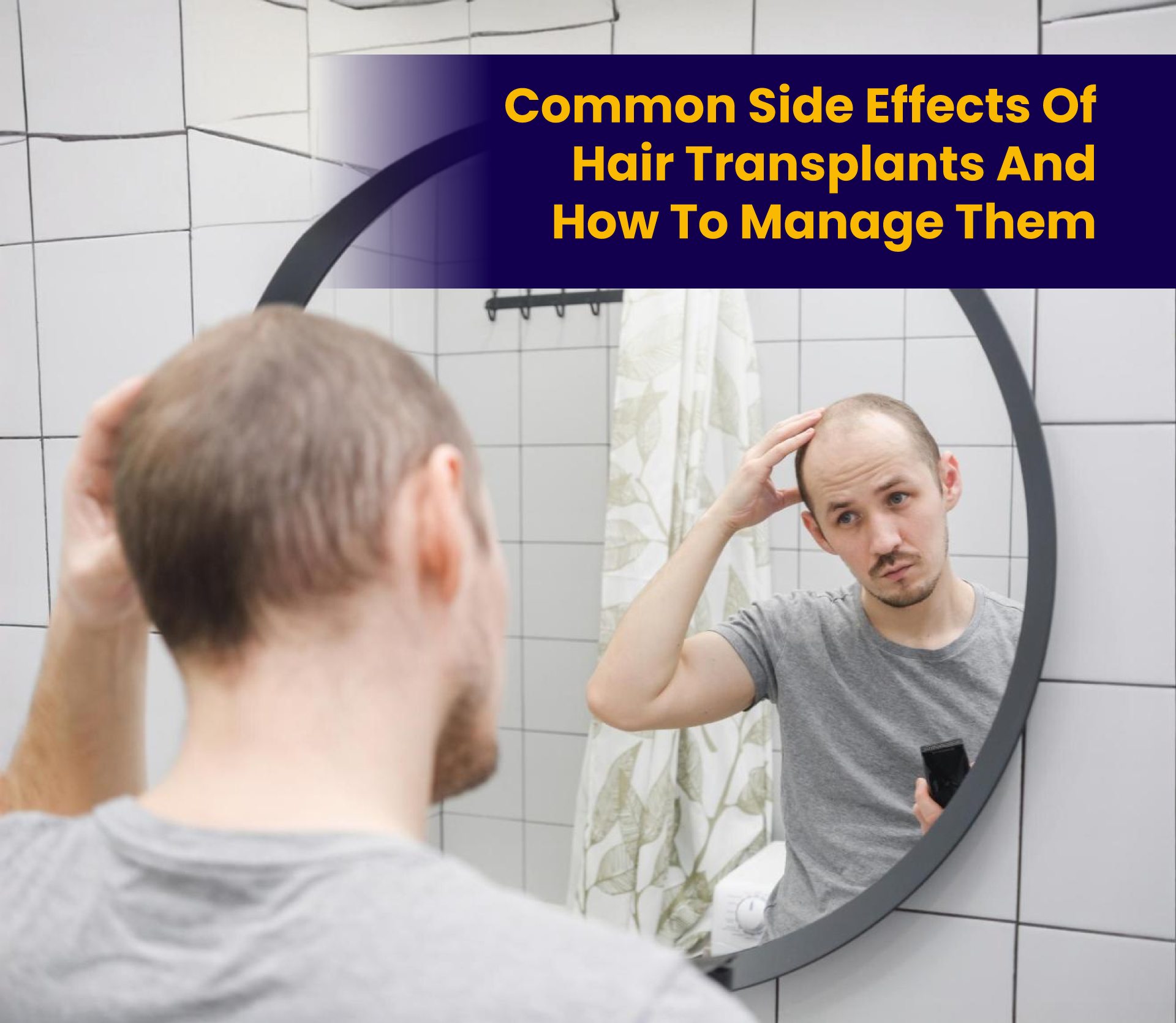 Common Side Effects of Hair Transplants and How to Manage Them