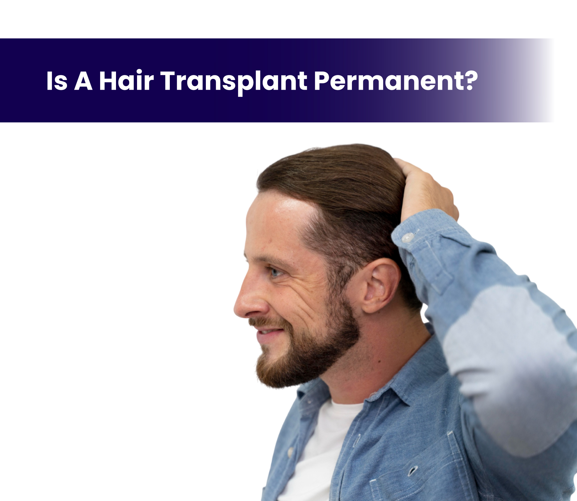 Is a Hair Transplant Permanent?