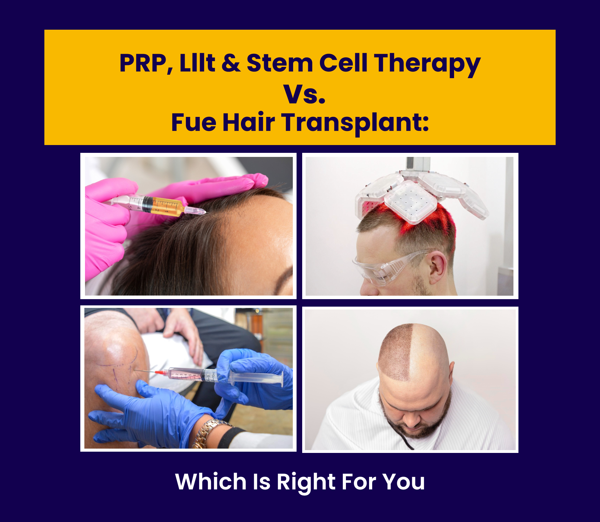 PRP, LLLT & Stem Cell Therapy vs. FUE Hair Transplant: Which Is Right for You?