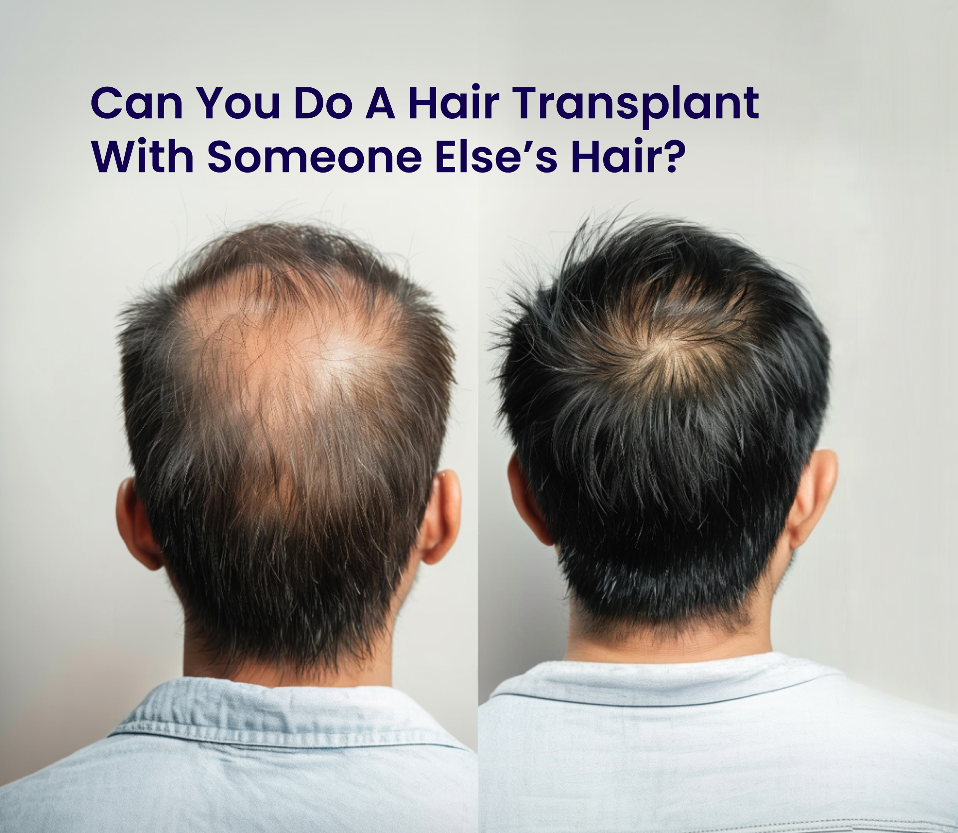 Can You Do a Hair Transplant with Someone Else’s Hair?