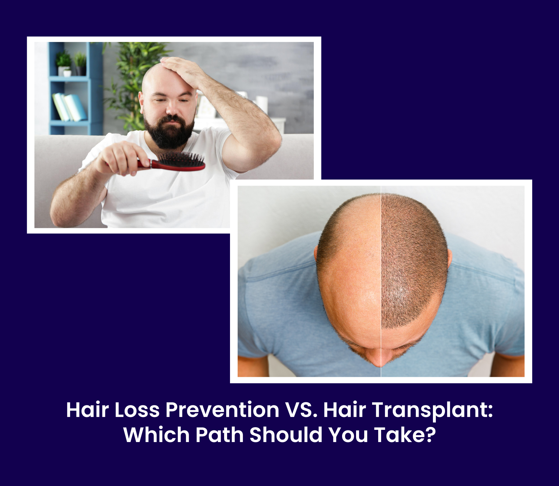 Hair Loss Prevention vs Hair Transplant: Which Path Should You Take?