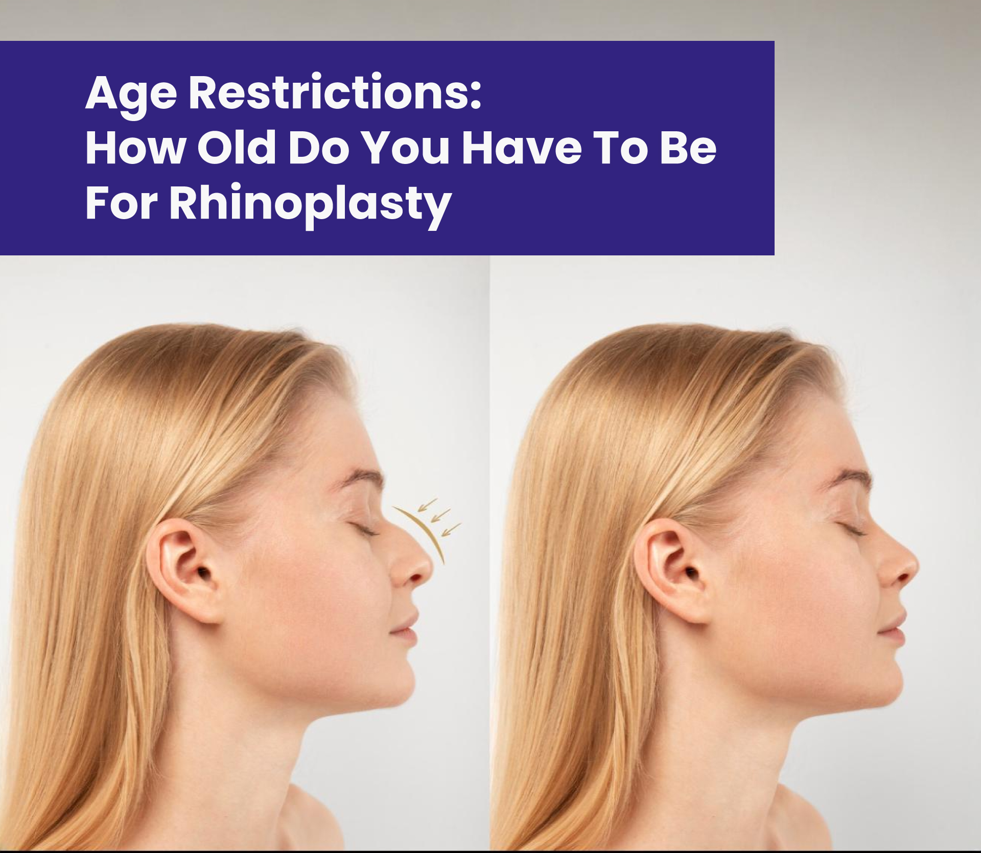 Age Restrictions: How Old Do You Have to Be for Rhinoplasty