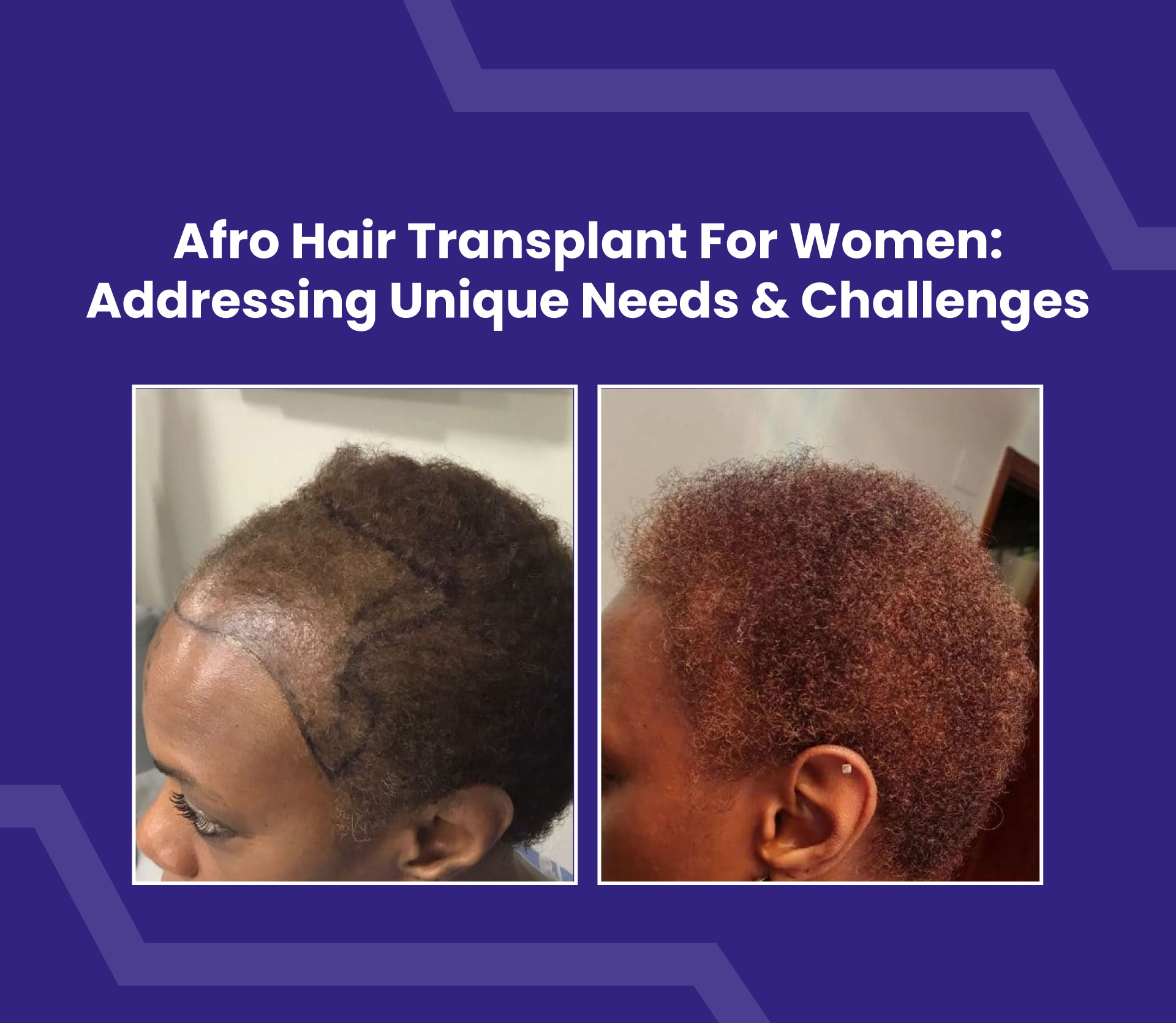 Afro Hair Transplant for Women: Addressing Unique Needs & Challenges
