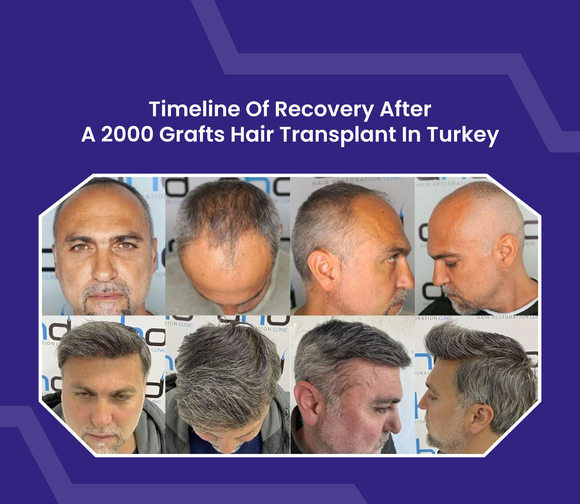 Timeline of Recovery After a 2000 Grafts Hair Transplant in Turkey