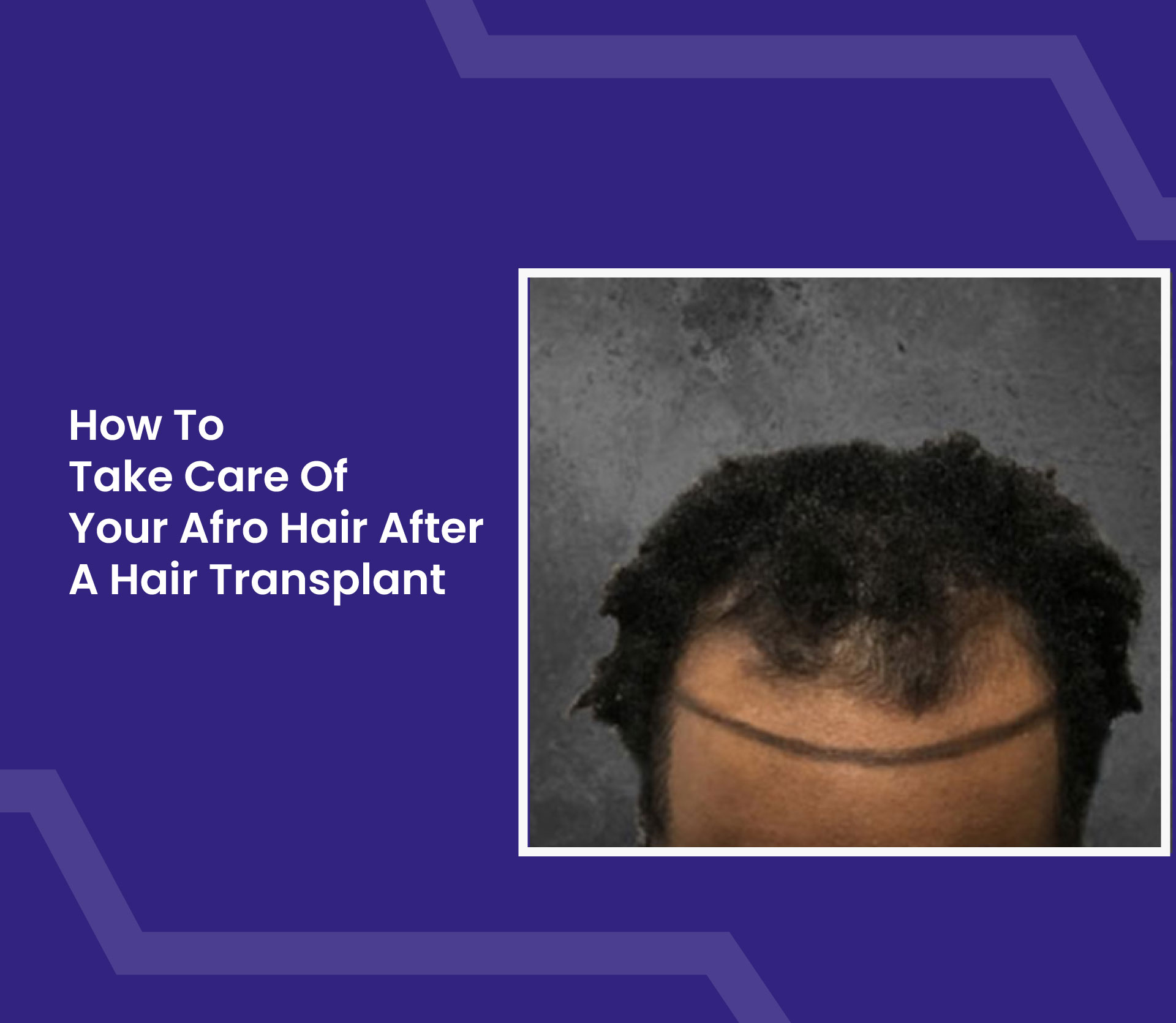 How to Take Care of Your Afro Hair After a Hair Transplant