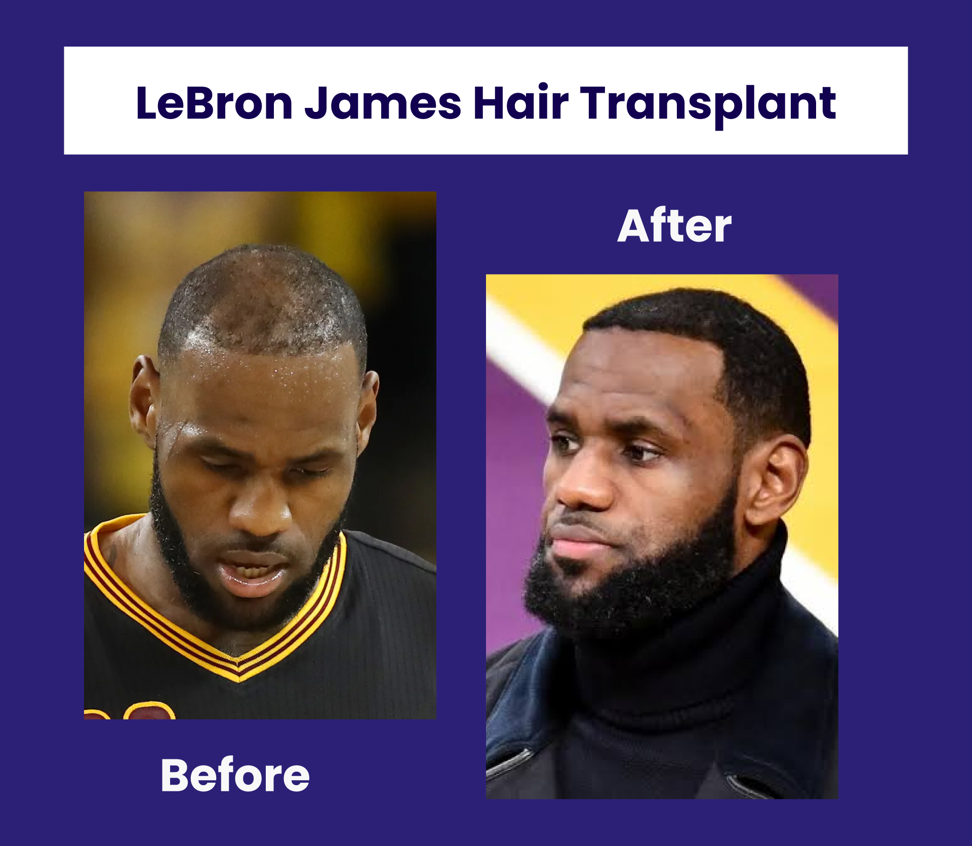 LeBron James Hair Transplant: Before and After