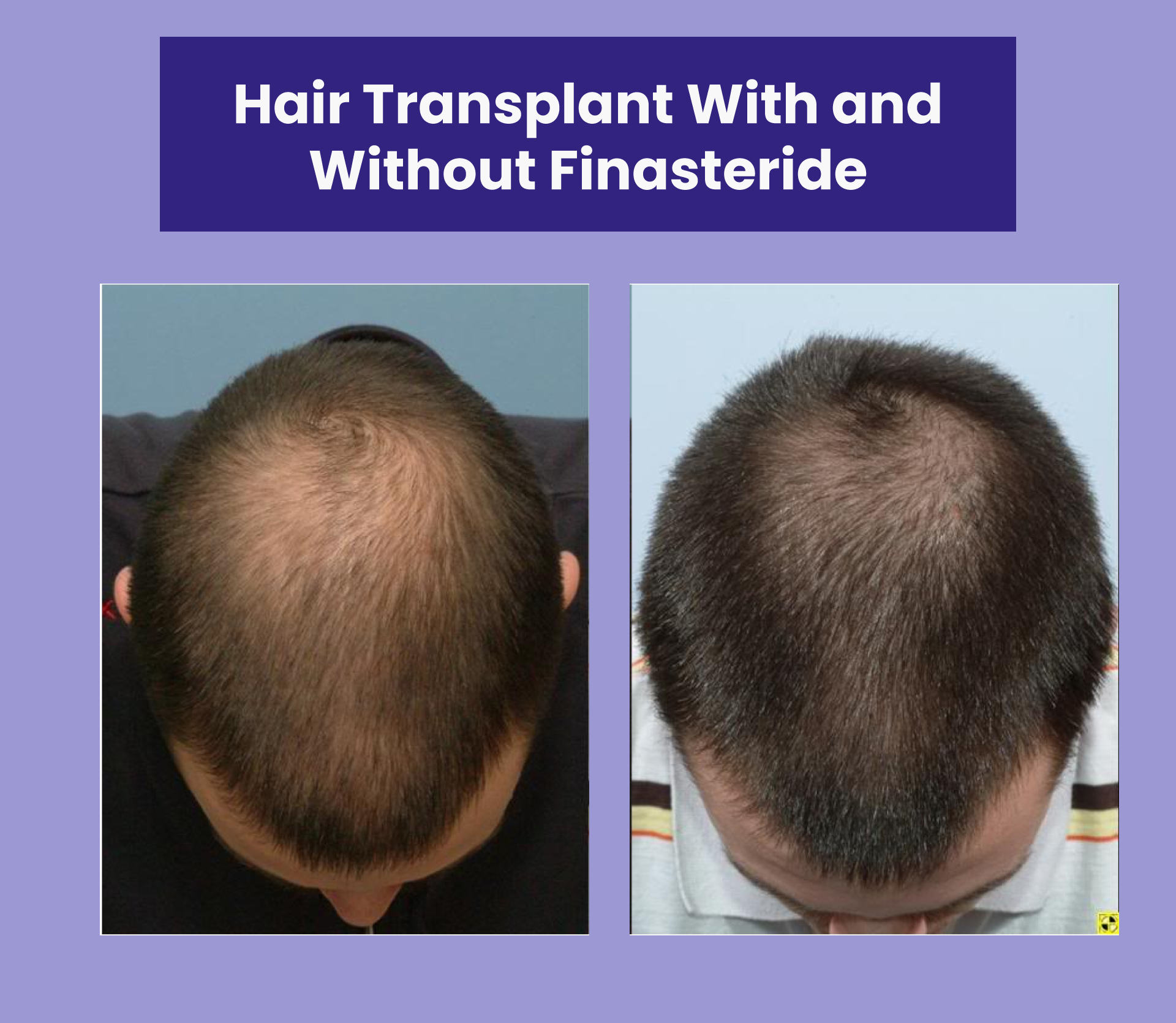 Hair Transplant With and Without Finasteride