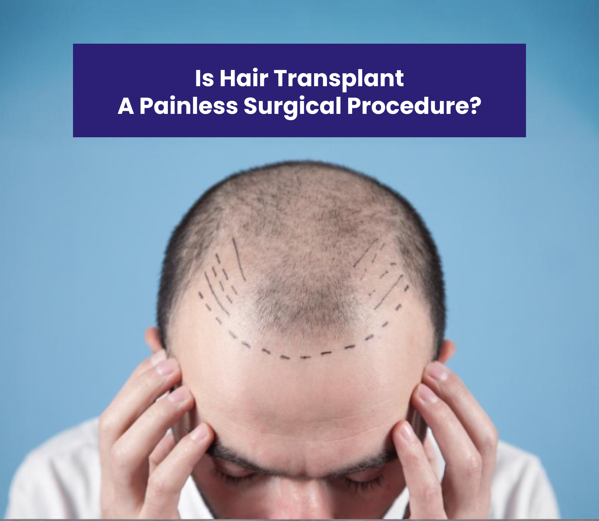 Is Hair Transplant a Painless Surgical Procedure?