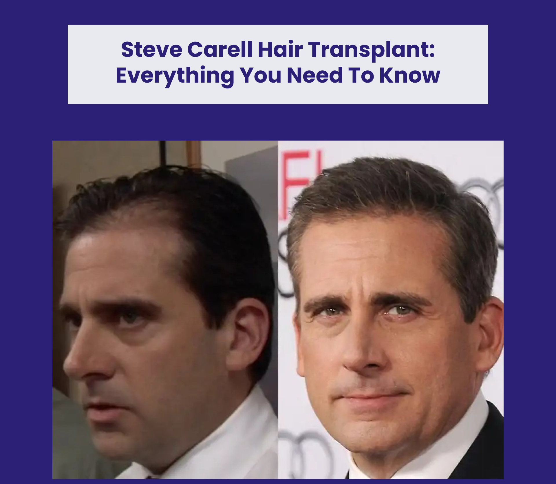Steve Carell Hair Transplant: Everything You Need To Know