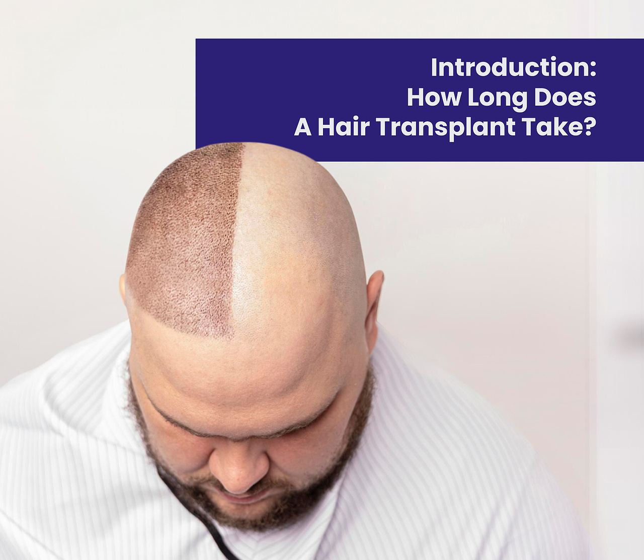 Introduction: How Long Does a Hair Transplant Take?
